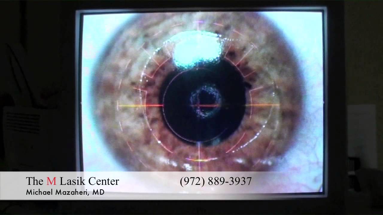 Watch Dr. Mazaheri Perform the No Cutting Version of LASIK Surgery