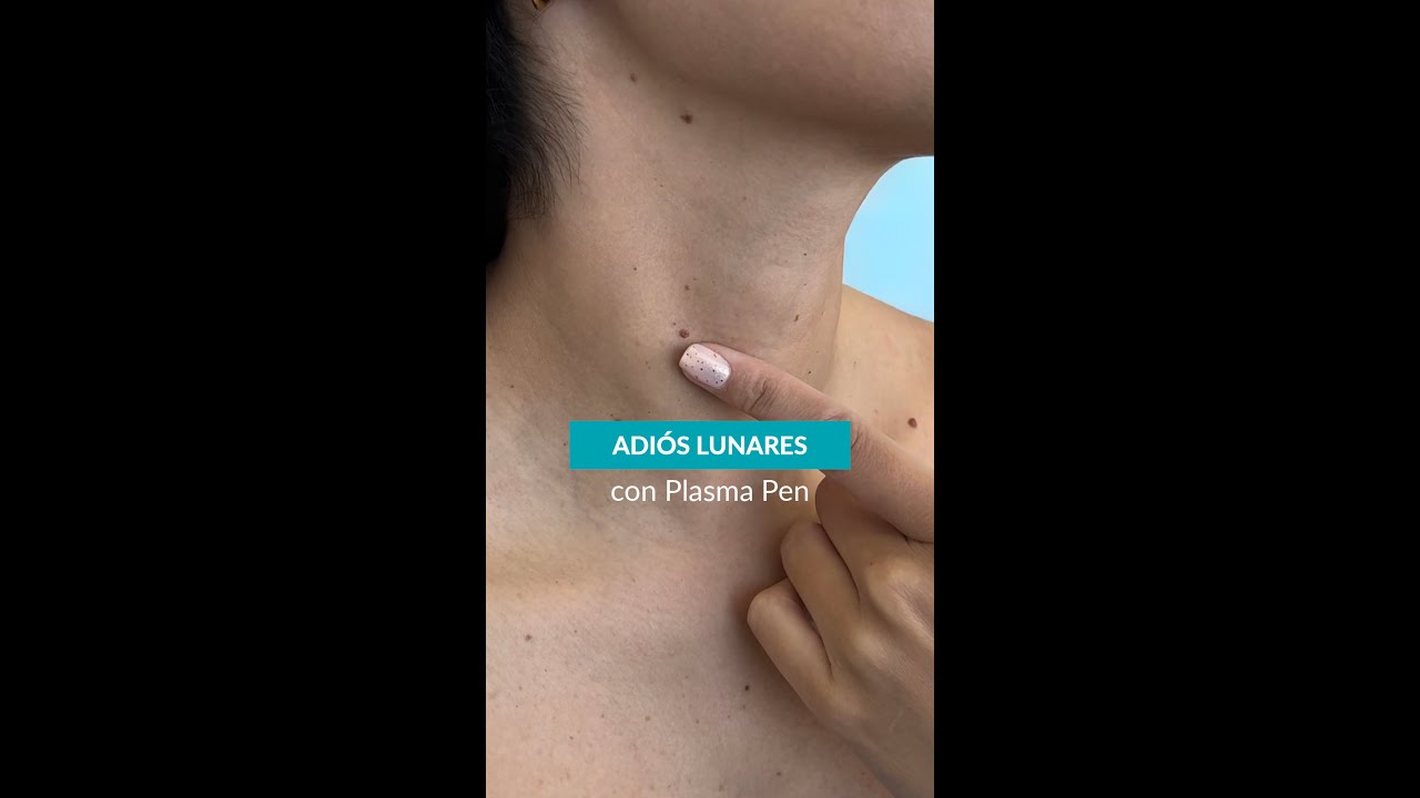 CAUTERIZACIÓN DE LUNARES