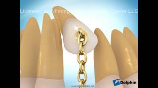Impacted Cuspid Labial Gold Chain Treated