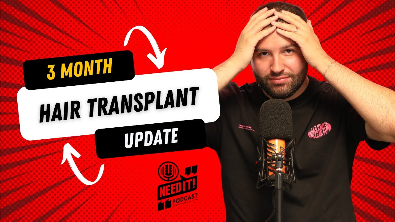 MY HAIR TRANSPLANT 3 MONTH UPDATE - YouTube