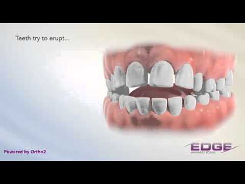 Edge Animations Tongue Thrust