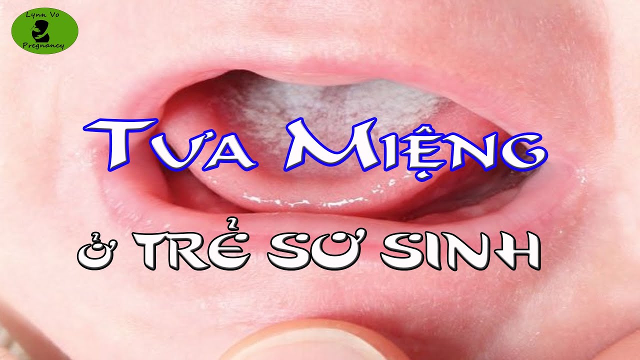 Trẻ BỎ BÚ Vì Bị Bệnh TƯA MIỆNG Nguyên Nhân Do Đâu Và Cách Phòng Tránh Tưa Lưỡi, Lưỡi Trắng