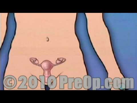 Histerectomía eliminación de útero, ovarios y trompas de falopio de Cirugía