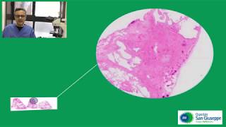 La Criobiopsia Polmonare Per La Diagnosi Di Fibrosi Polmonare Idiopatica