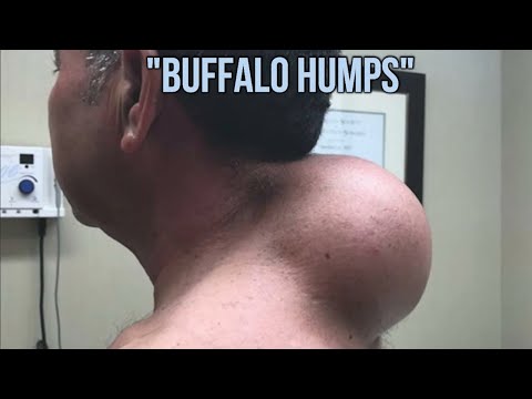 Buffalo Humps! What Are They?