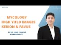 Mycology high yield images kerion  favus by dr sonu panwar
