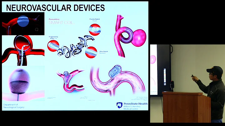 Intracranial Venous Stenting for Idiopathic Intrac...
