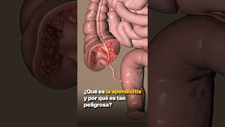 ¿Qué es la apendicitis y por qué es tan peligrosa?