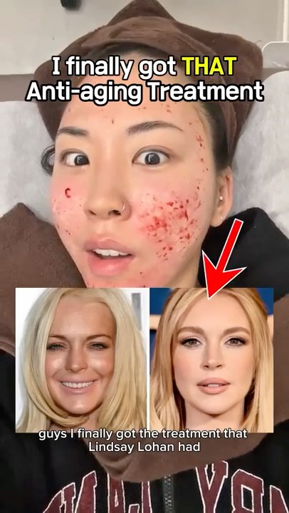 Got the Ultimate Skin Booster treatment🤔