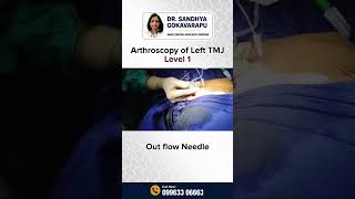 Arthroscopy of left TMJ LEVEL 1 | Dr. Sandhya Gokavarapu