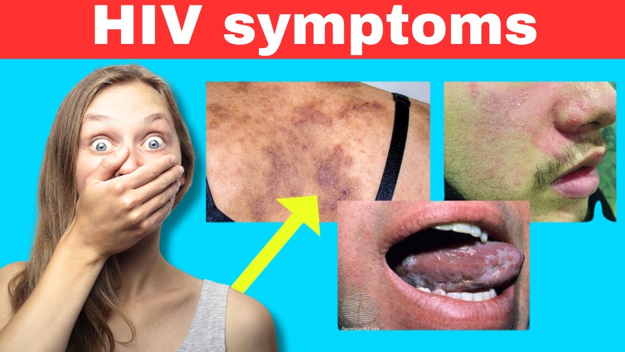 Early Signs of HIV You Should NEVER Ignore – Know the Symptoms! - YouTube