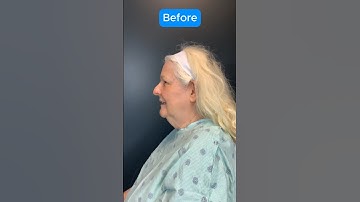 UNREAL Facelift Transformation (BEFORE AFTER) #facelift