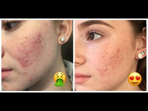 how-to-get-rid-of-your-acne-in-2-weeks!!-|-geneva-estavillo