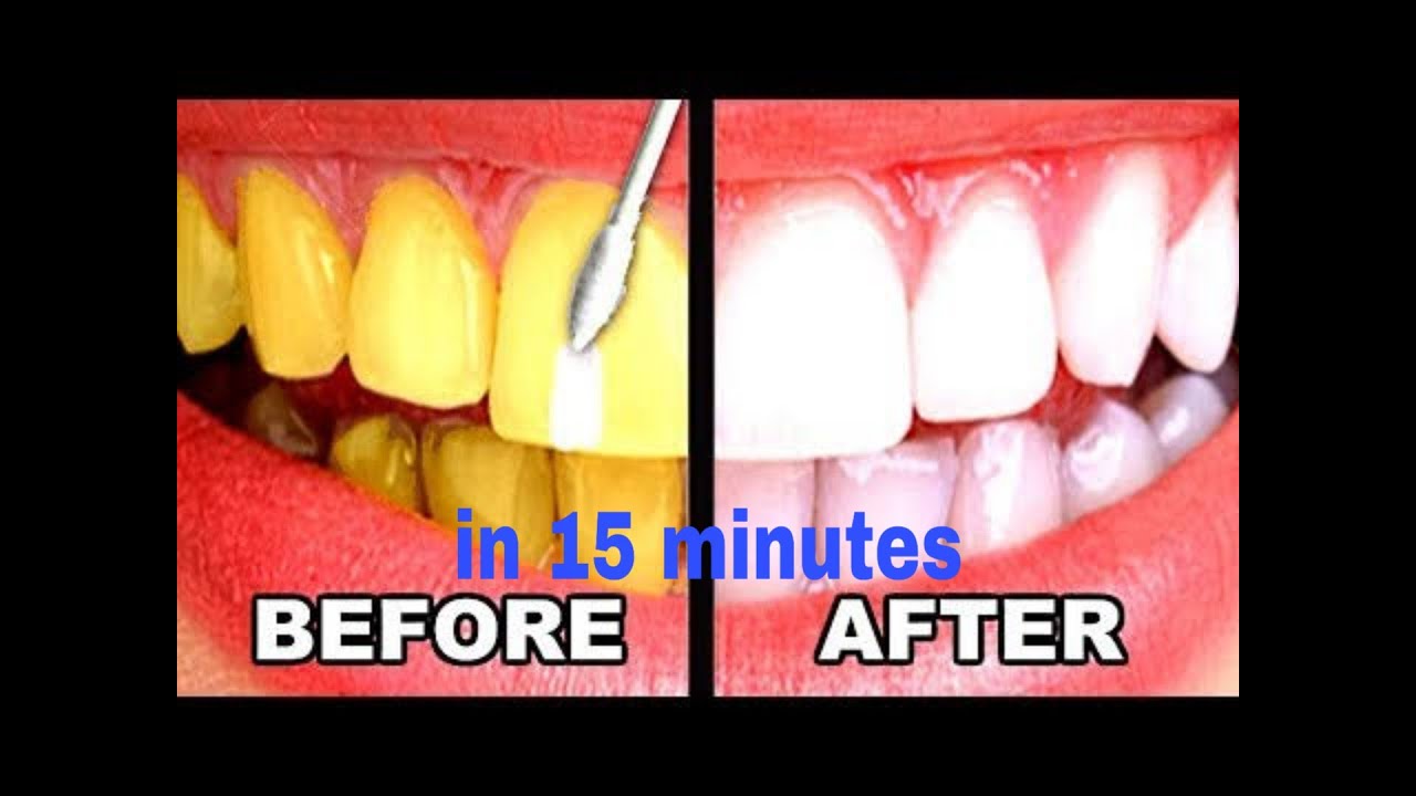 How To Clean Yellow Teeth In Just 15 Minutes YouTube how-to-clean-yellow-teeth-in-just-15-minutes-youtube