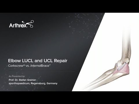 Elbow LUCL and UCL Repair - Corkscrew® vs. InternalBrace™ - YouTube