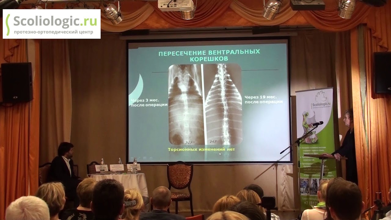 Корсет Шено. Лечение сколиоза у детей. - YouTube