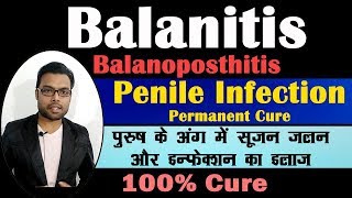 Treatment Of Balanitis | पुरुष के अंग में सूजन जलन और इन्फेक्शन का इलाज | Balanitis | Balantis