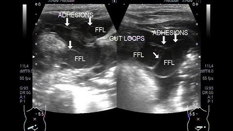 Ultrasound Video showing Intestinal perforation.