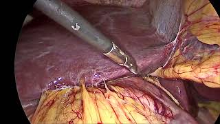 Residual Gallbladder - Laparoscopic Completion Cholecystectomy | Dr Abhimanyu Kapoor