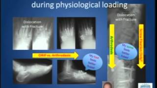 Midfoot Fractures: Are Lisfranc Injuries Better Treated with Internal Fixation and Fusion?