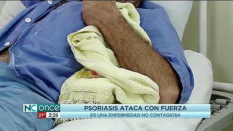 ¿Cómo afecta la psoriasis al corazón?