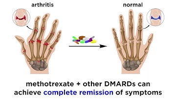 Methotrexate (Rheumatoid Arthritis Drug)