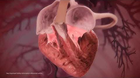 MitraClip Procedure Animation Video