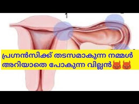 Hidden cause of female infertility// tubal block