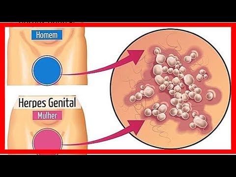 Hier ist, wie Sie die Symptome von Herpes genitalis identifizieren