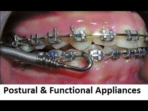 How Fixed, Functional & Postural Appliances Differ From Each Other by Prof John Mew