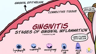 Gingivitis: Stages of Gingival Inflammation