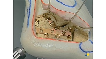 Calcaneus - Comminuted Fractures - Open Reduction and Internal Fixation