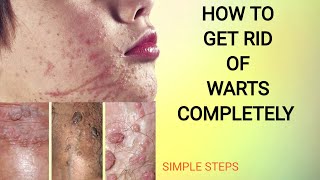 Warts Be Gone! Uncover the Secret to Banishing Those Pesky Warts Instantly! screenshot 4