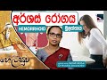 අර්ශස් ( HEMORRHOID ) හෙවත් මූලග්ගාය