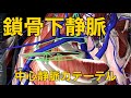【鎖骨下静脈】中心静脈カテーテルで押さえるべきポイント3つ!