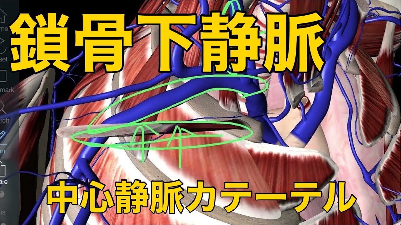 【鎖骨下静脈】中心静脈カテーテルで押さえるべきポイント3つ！