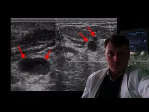 Video: Ultrasound Of The Mammary Glands - Preparation, Contraindications