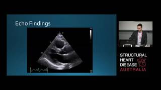 Atrial Mass: The Heart of the Matter - Mr Matthew Hunt