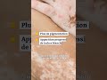 Il existe dorénavant un traitement contre le vitiligo