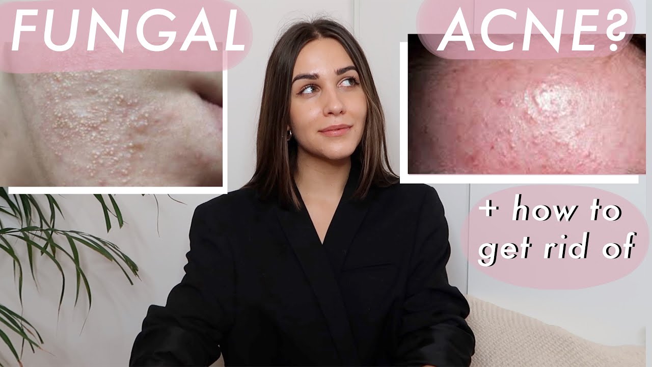 How to get rid of LITTLE BUMPS on your face FUNGAL ACNE