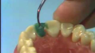 Dental Anatomy: Waxing a Maxillary Central Incisor