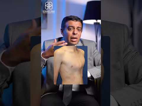 بروز الصدر صدر الحمامة تشوه الصدر عند الاطفال مش دايما نقص كالسيوم