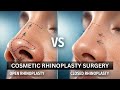 Cosmetic Rhinoplasty Surgery | Nose Job Explained | Open vs Closed Rhinoplasty