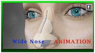 Rhinoplasty Animation - How can a Wide nose be narrowed?