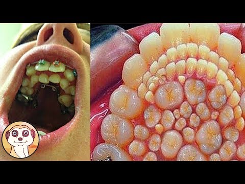 QUESTO BAMBINO HA 300 DENTI NELLA SUA BOCCA!