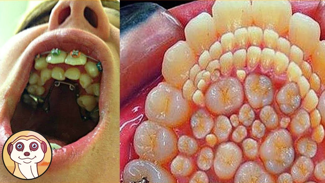 QUESTO BAMBINO HA 300 DENTI NELLA SUA BOCCA! YouTube