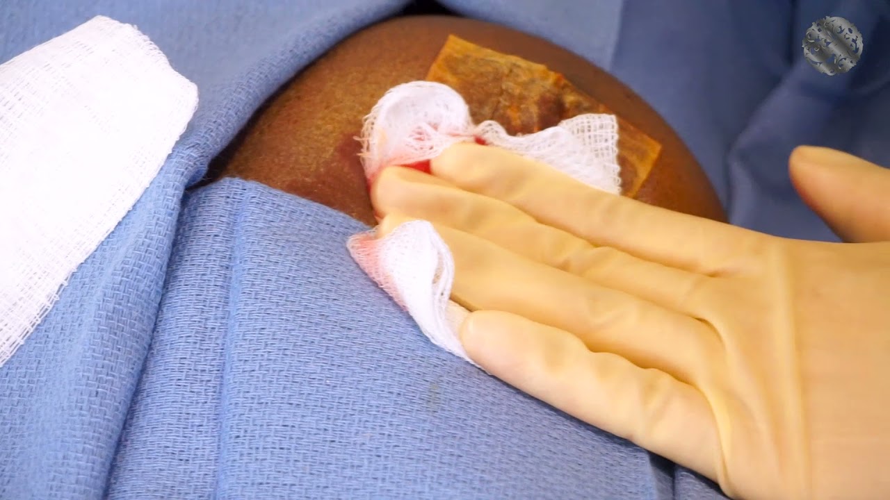 Scar Treatment in Los Angeles CA | Beverly Hills Scar Revision Surgery