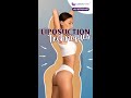 The Best Plastic Surgeon in Adajan, Dr. Rushin B. Thakor’s Expert Liposuction Techniques.