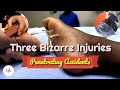 Three bizarre accidental injuries