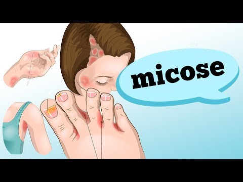 Vídeo: Você deve cobrir a micose?